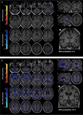Automatic MRI volumetry in asymptomatic cases at risk for normal pressure hydrocephalus